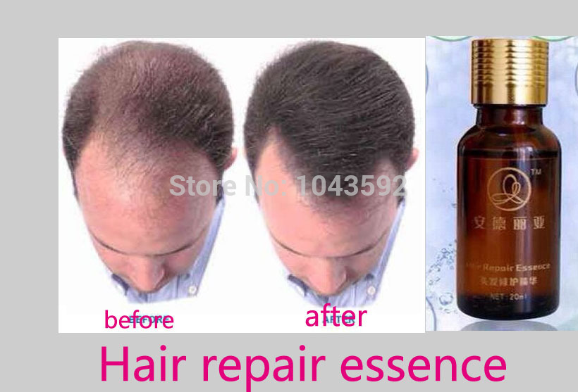 regrow hair after psoriasis